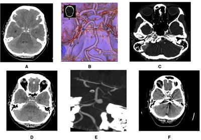 Anterior inferior cerebellar artery (AICA) aneurysms: a radiological study of 15 consecutive patients